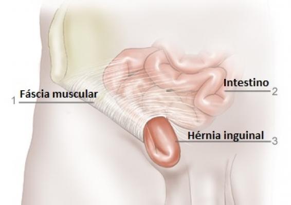 Hérnia do esporte: causas, sintomas e tratamentos - Hernia Clinic